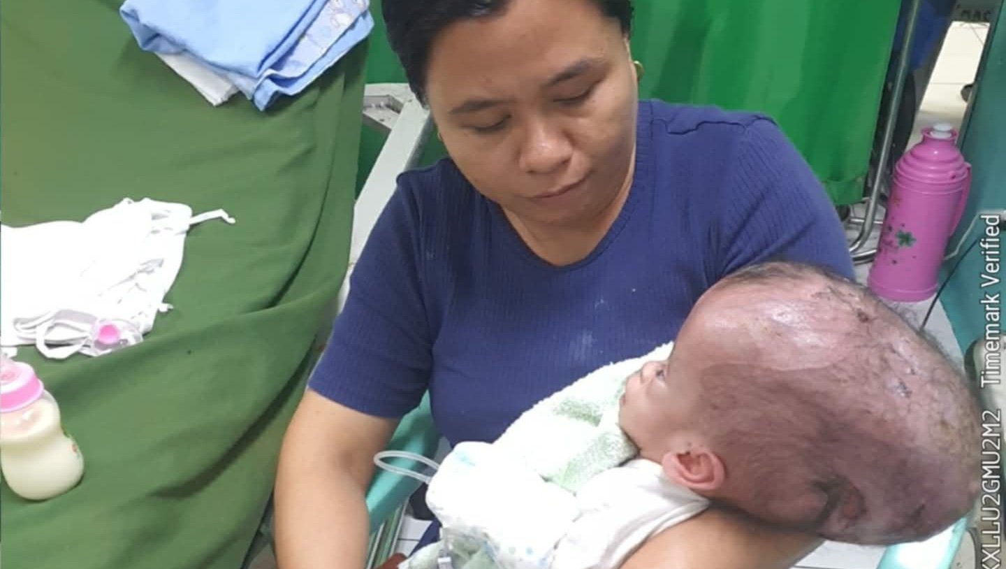 Help baby Sofia fight hydrocephalus